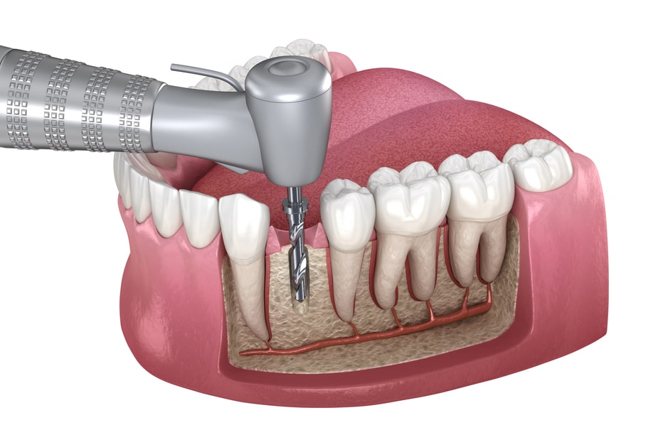 Root Canal Treatment Klinik Pergigian Azman