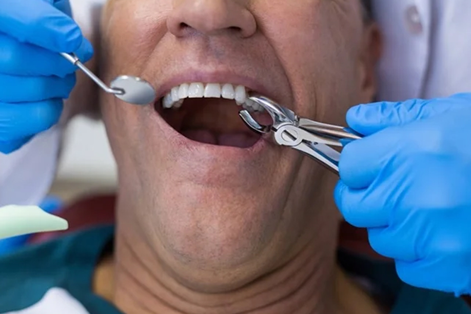 Dental Extraction